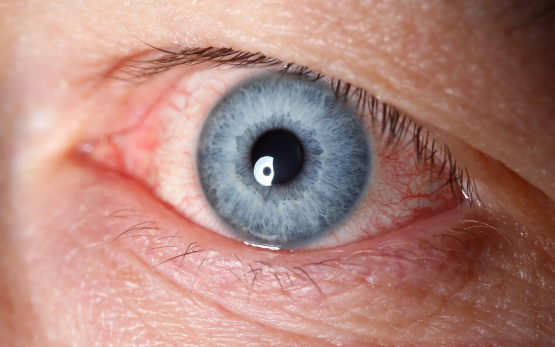 What a Dry Eye Exam Looks Like | Dr. Shaver