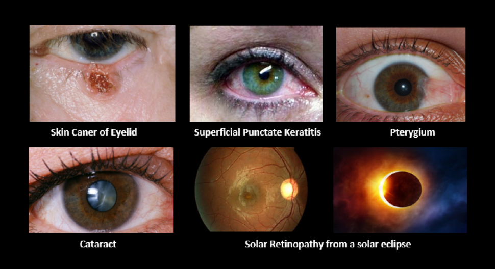 Photo showing skin cancer of the eyelid, superficial punctate keratitis, pterygium, and a cataract.